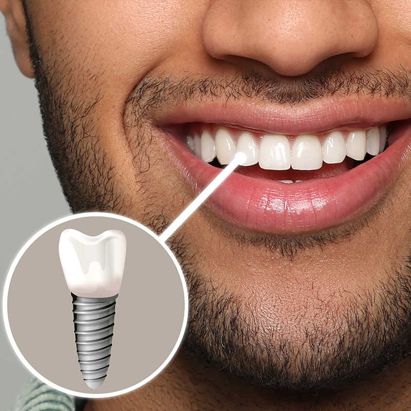 An image of a smiling man with a toothpaste-colored toothpaste tube placed over his teeth, highlighting the presence of a dental implant.